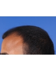 Before Hair Transplant&nbsp;Front